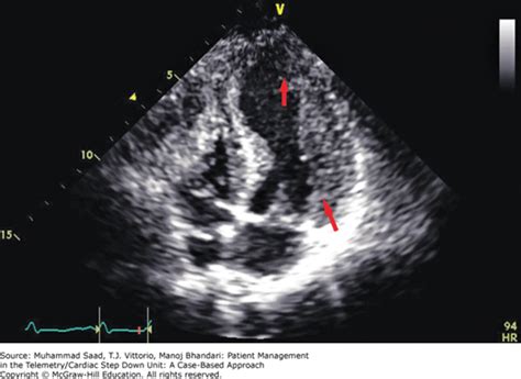 bad echocardiogram results|Talking With Your Doctor About Echocardiogram Results.